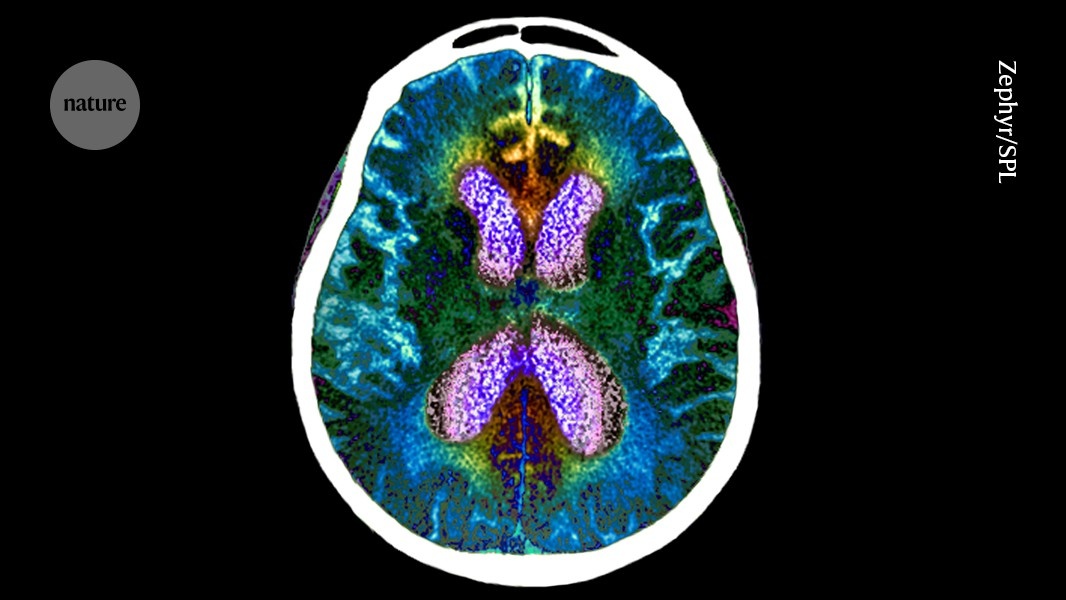 Resiliência Cognitiva: A Nova Chave para Entender e Prevenir o Alzheimer