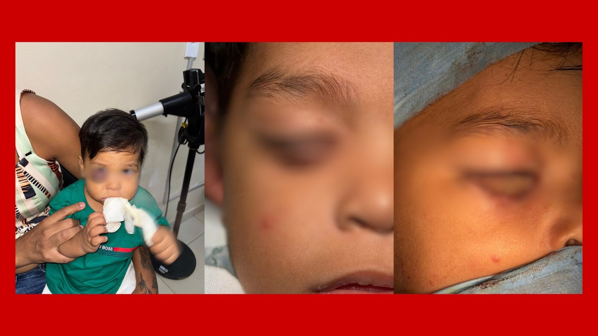 Criança de 1 ano passa por cirurgia complexa para reconstrução de pálpebra no DF