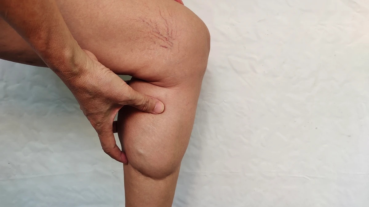 Lipedema e o Paradoxo do Exercício: Quando a Busca por Saúde Exige uma Nova Bússola