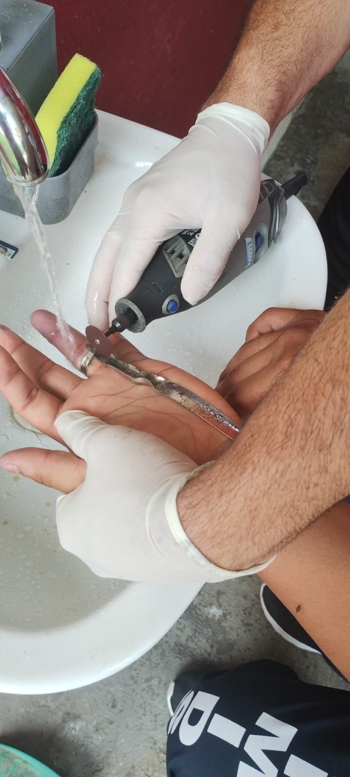 Manaus Alerta: O Crescimento Alarmante de Resgates por Anéis Presos e Seus Reflexos na Saúde Pública e Prevenção