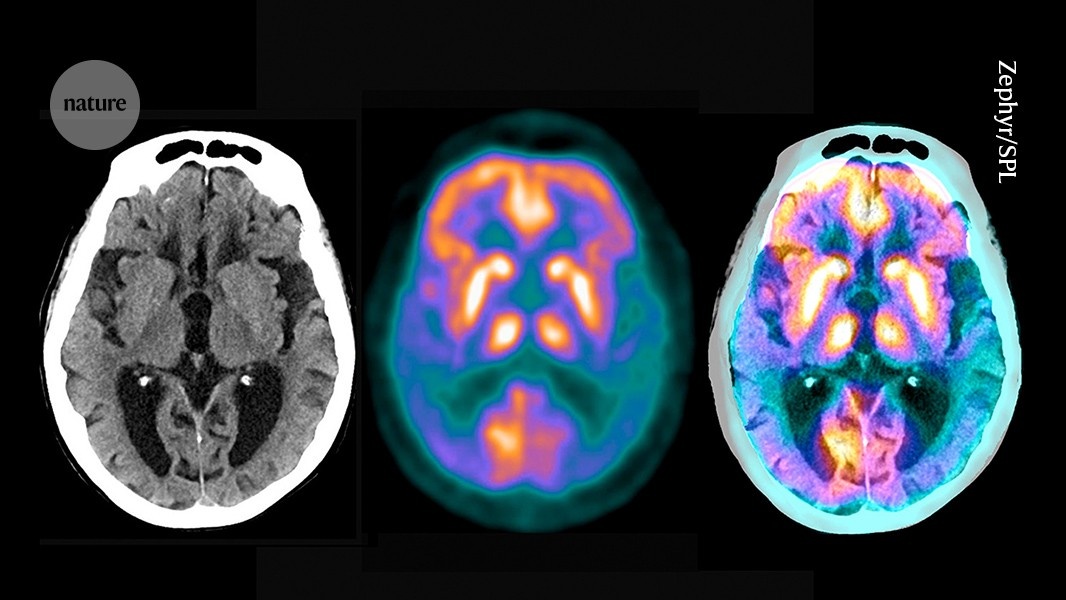 Mapeamento Inédito de Microproteínas Cerebrais Abre Novas Fronteiras na Compreensão do Alzheimer