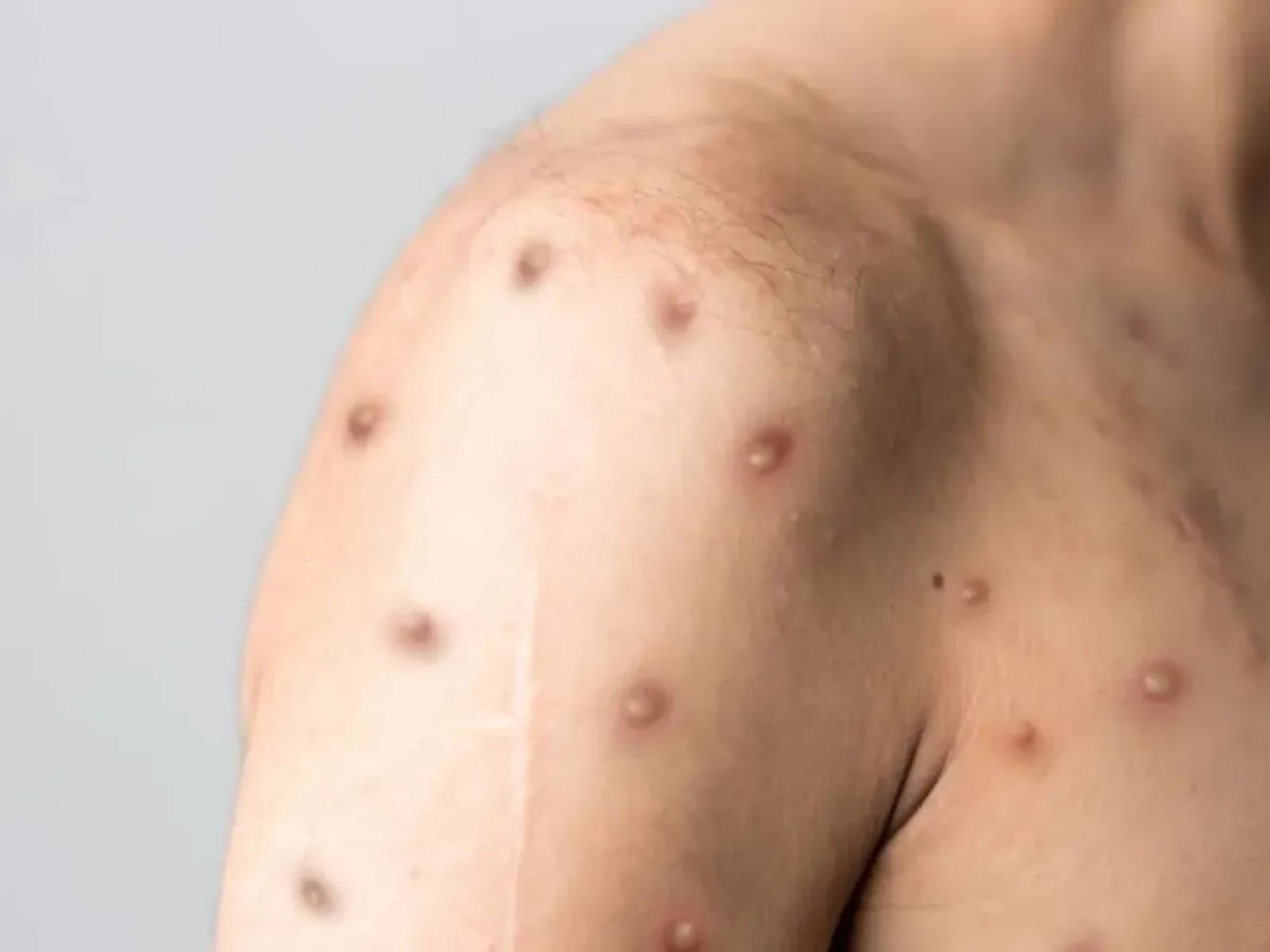 Análise: O Recrudescimento da Mpox no RN e os Desafios da Vigilância Regional