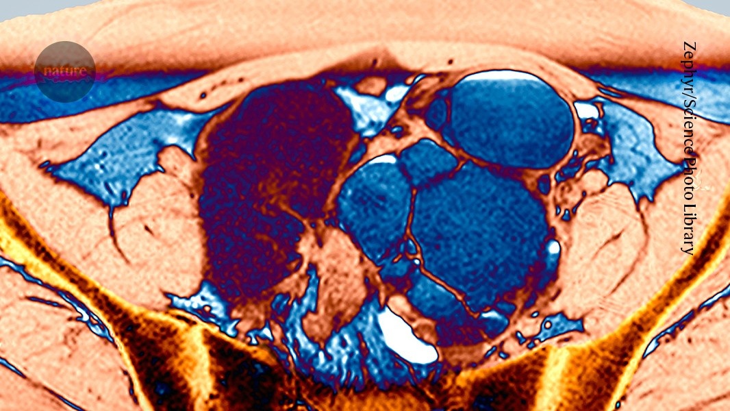 Tratamento promissor para endometriose avança a campo da medicina